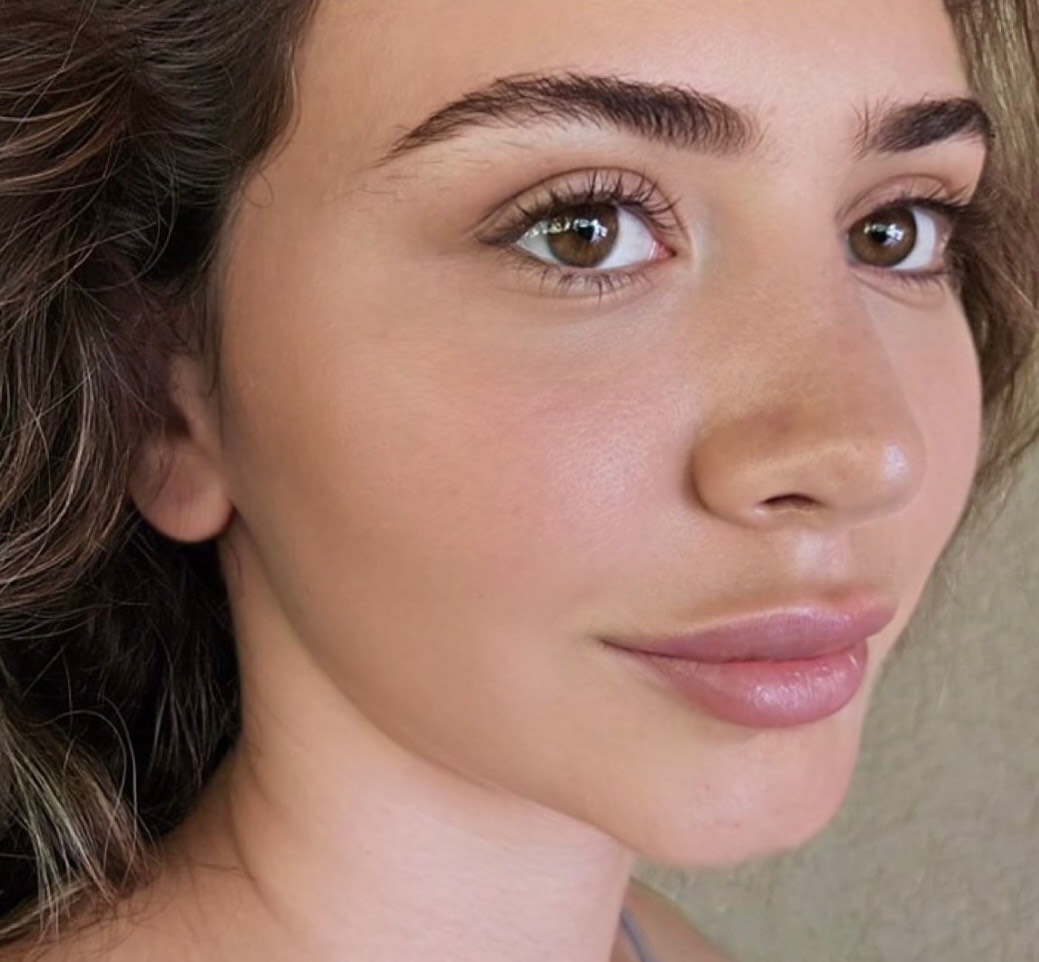 Genesis Laser Results