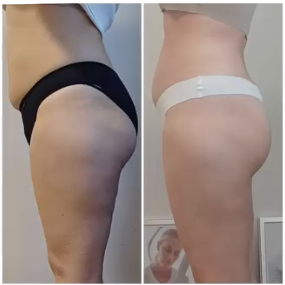 Icoone Laser Med Result 3