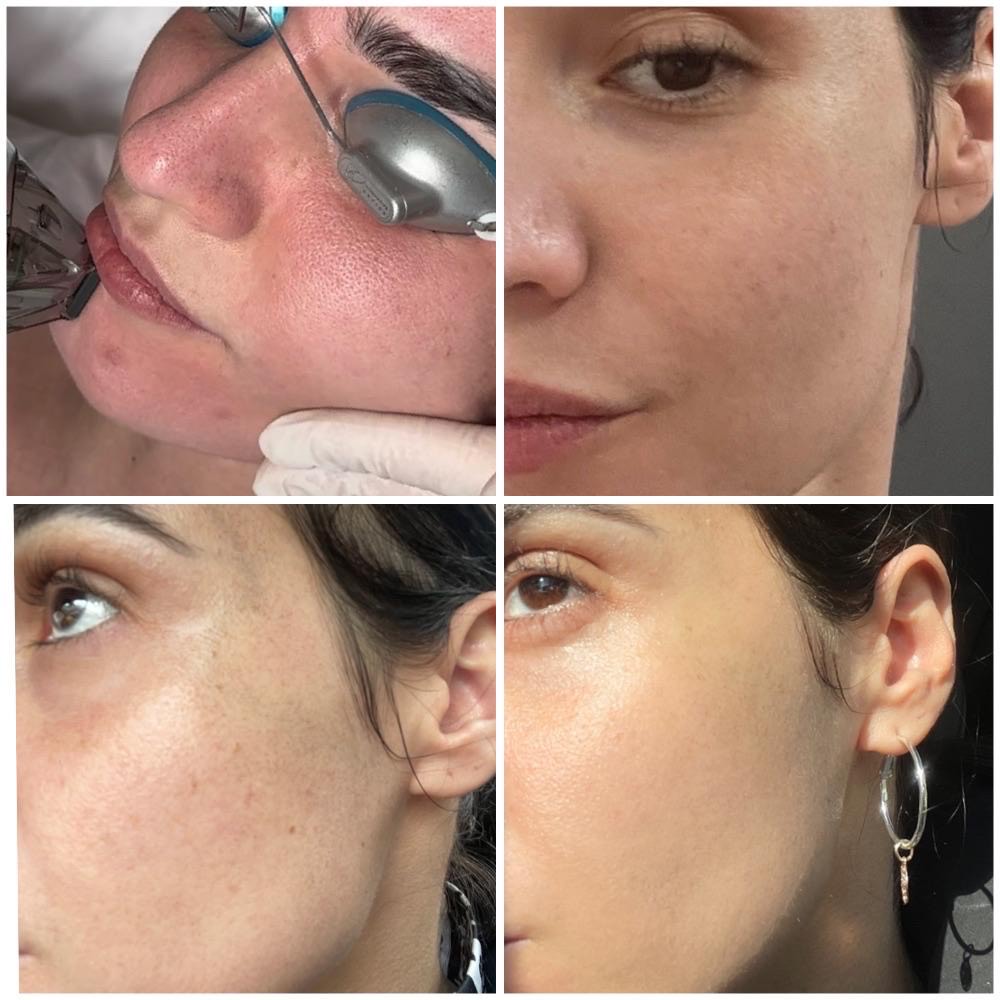 MOXi laser treatment results