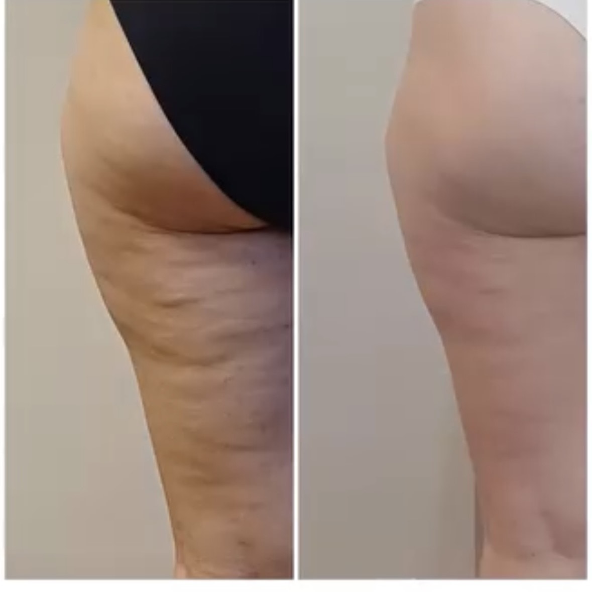 Icoone Laser Med Result 2