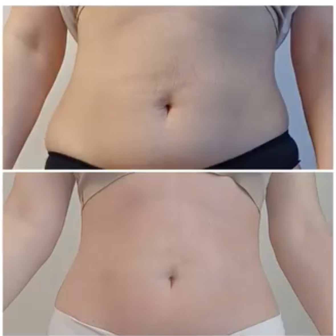 Icoone Laser Med Result 1