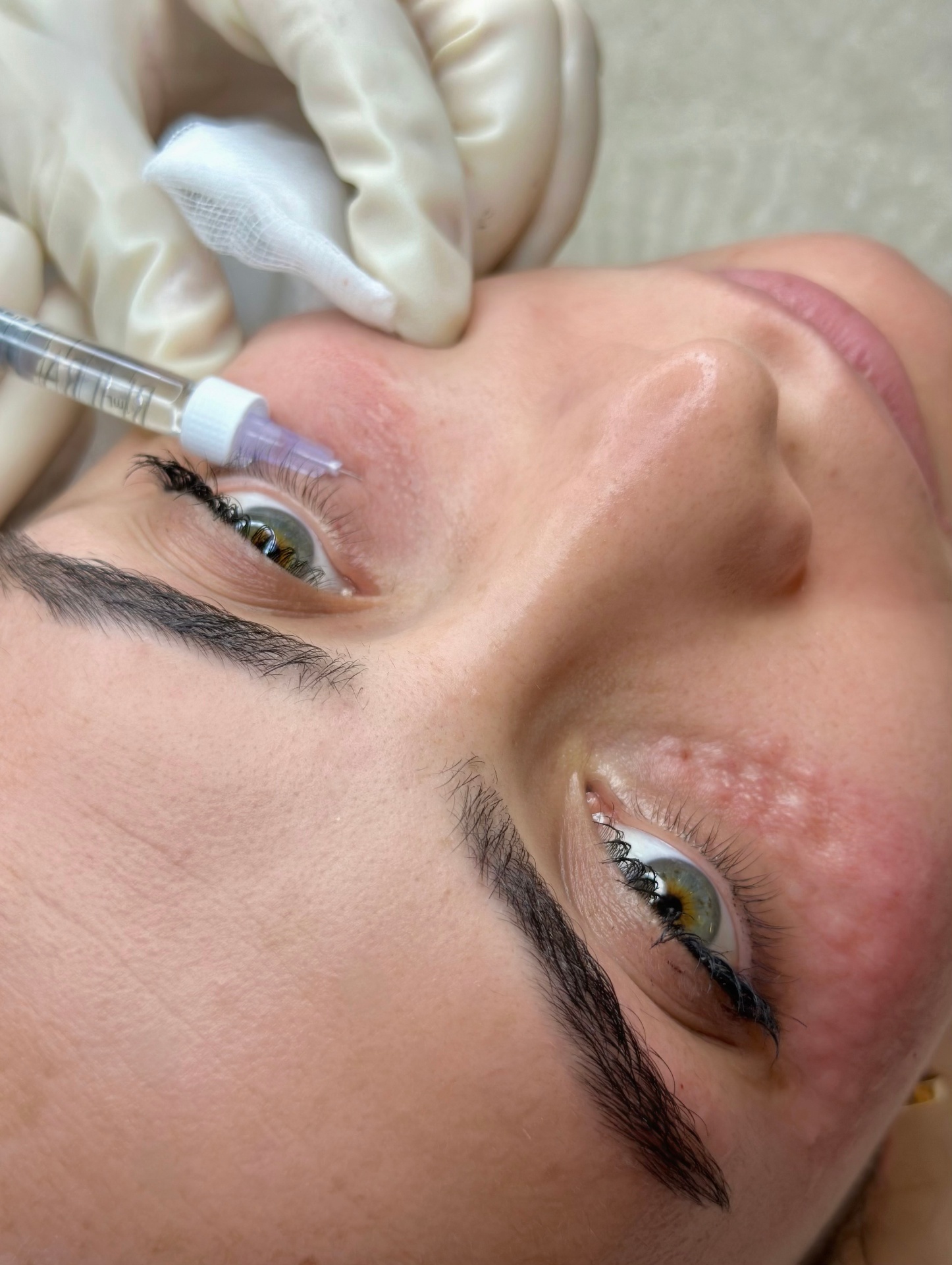 Rejuran Process