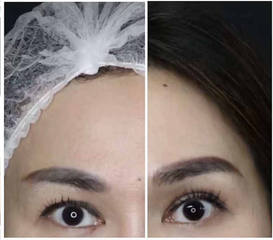 Sofwave treatment before and after results 5