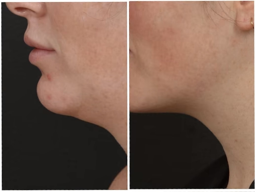 Sofwave treatment before and after results 3