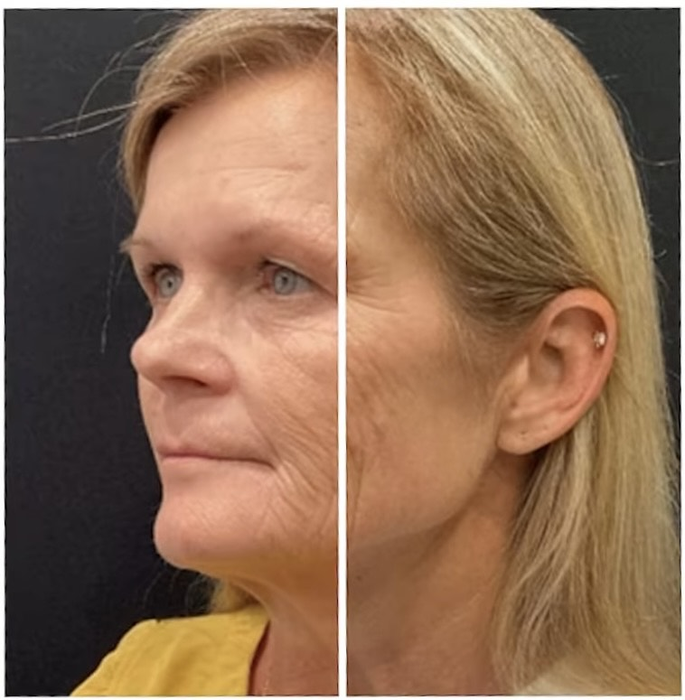 Sofwave treatment before and after results 6