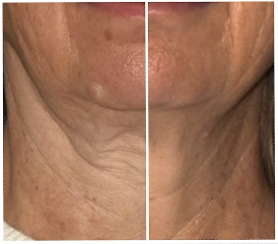Sofwave treatment before and after results 4