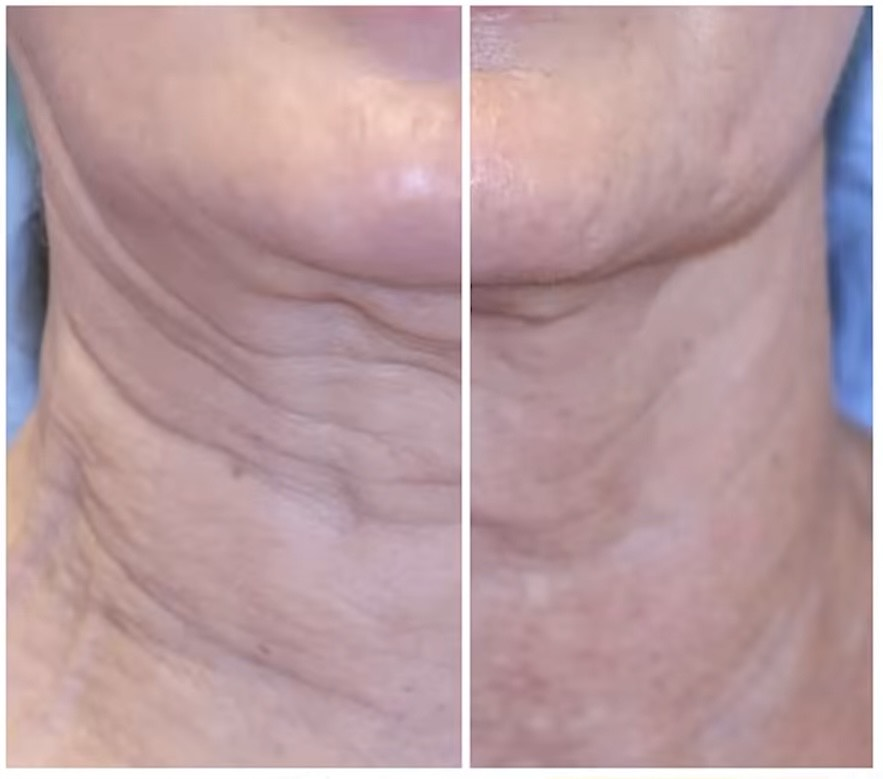 Sofwave treatment before and after results 1