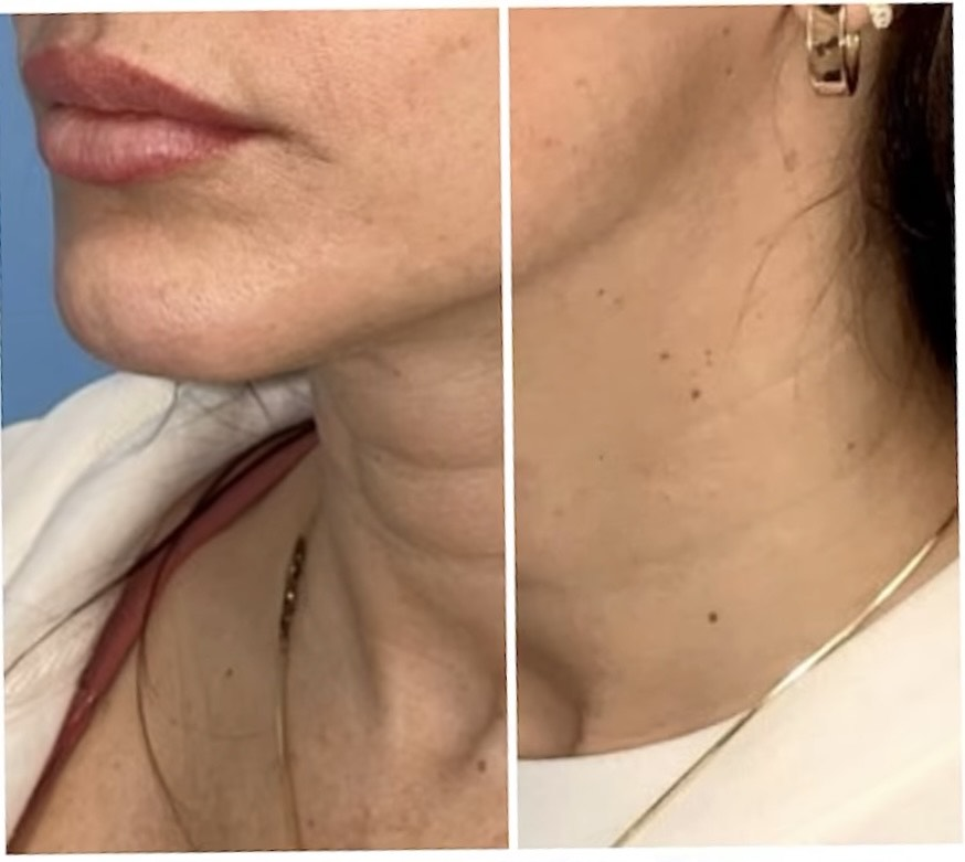 Sofwave treatment before and after results 2