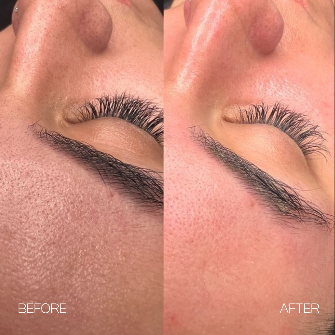 Chemical Peel Result