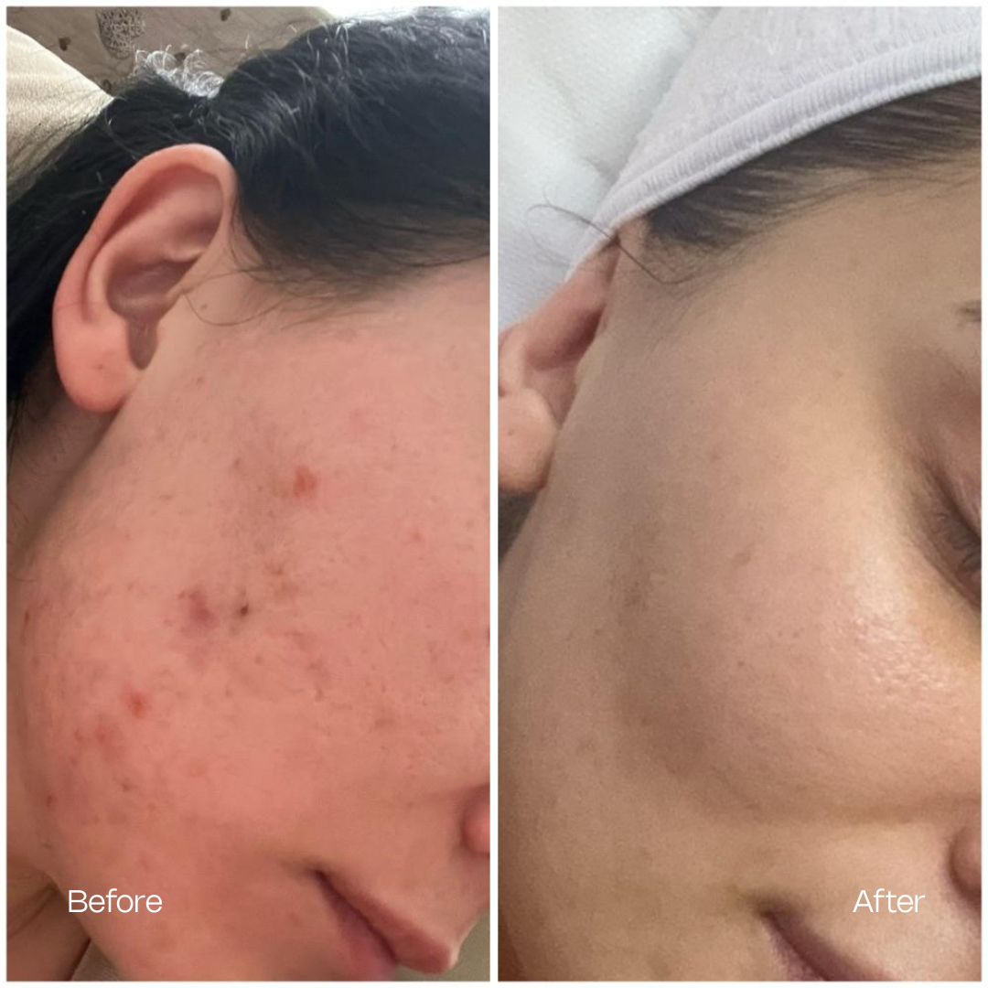 Dermapen 4 Result